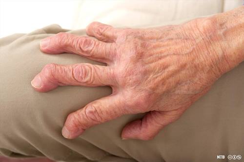 hand afflicted by polyarthritis, woman 82 years old, color