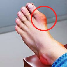 text: red swelling on big toe of a foot