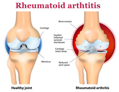 color diagram of a healthy joint (left) and one with Rheumatoid arthritis (right) showing the parts